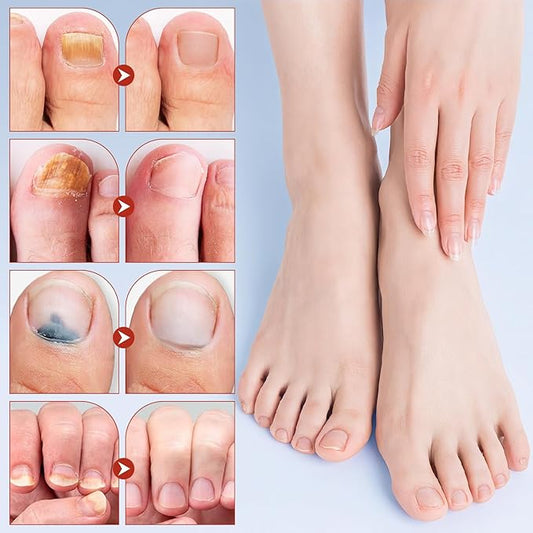 PACK 2 Parche hongo De Uñas (42unid)