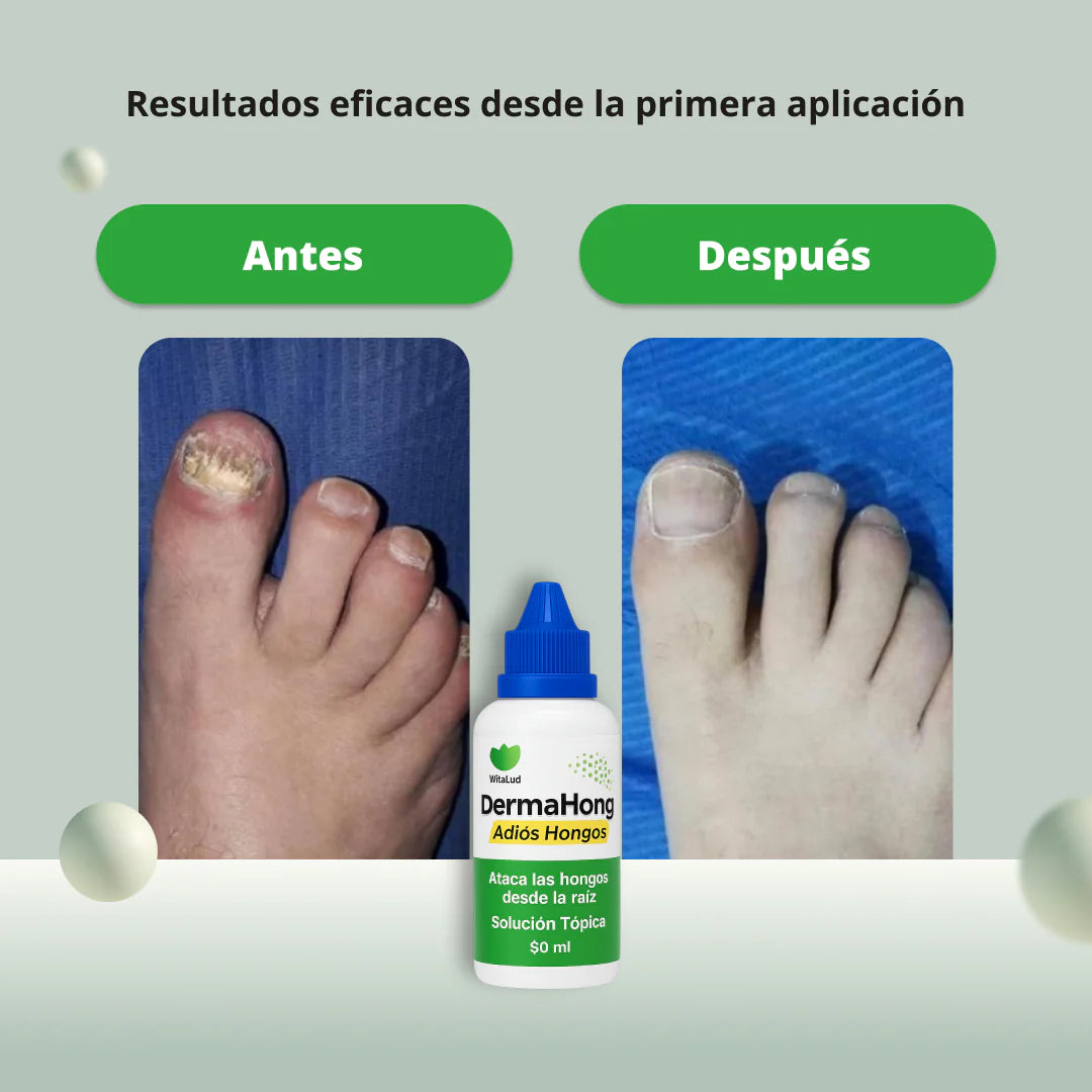 DERMAHONG - Elimina de raíz cualquier hongo